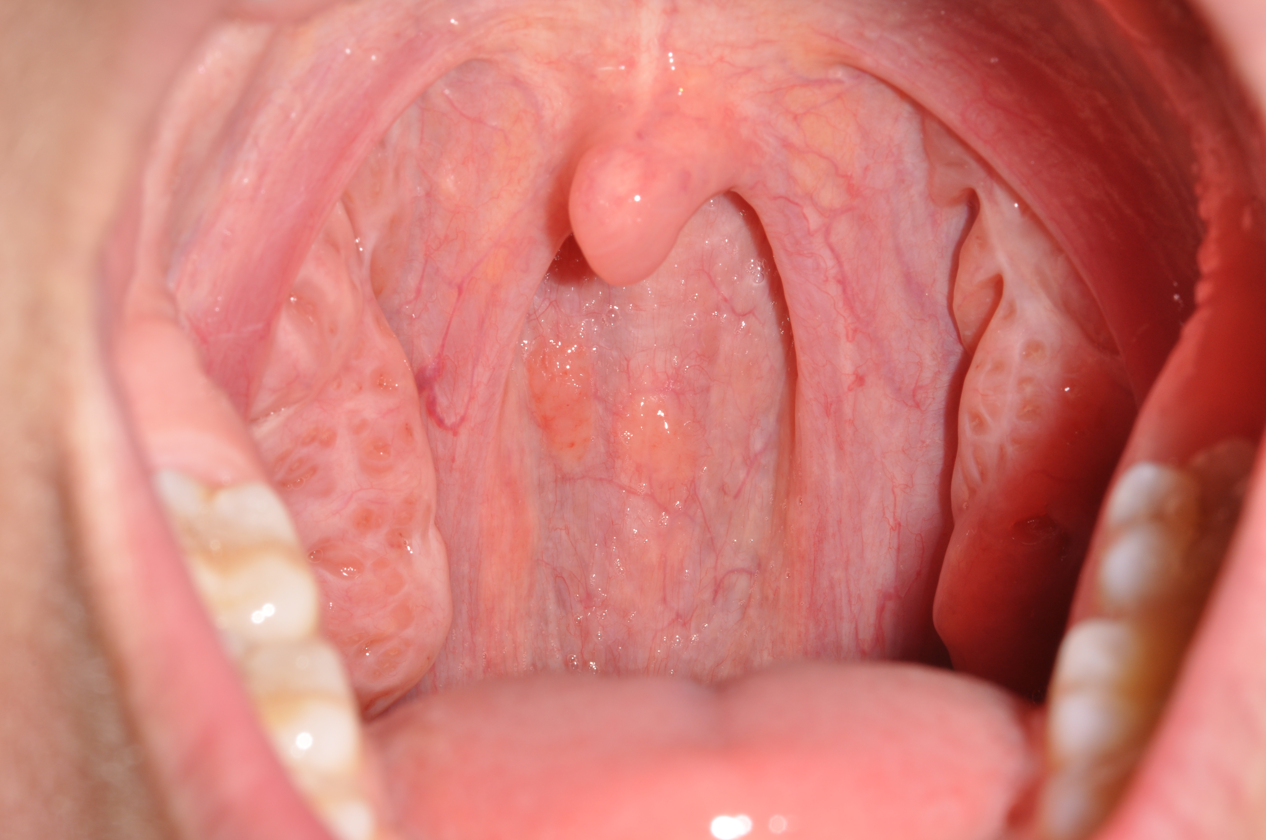 normal throat