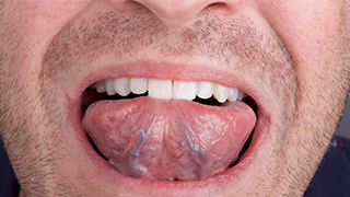 SOCS step 4 - undersurface of tongue 2